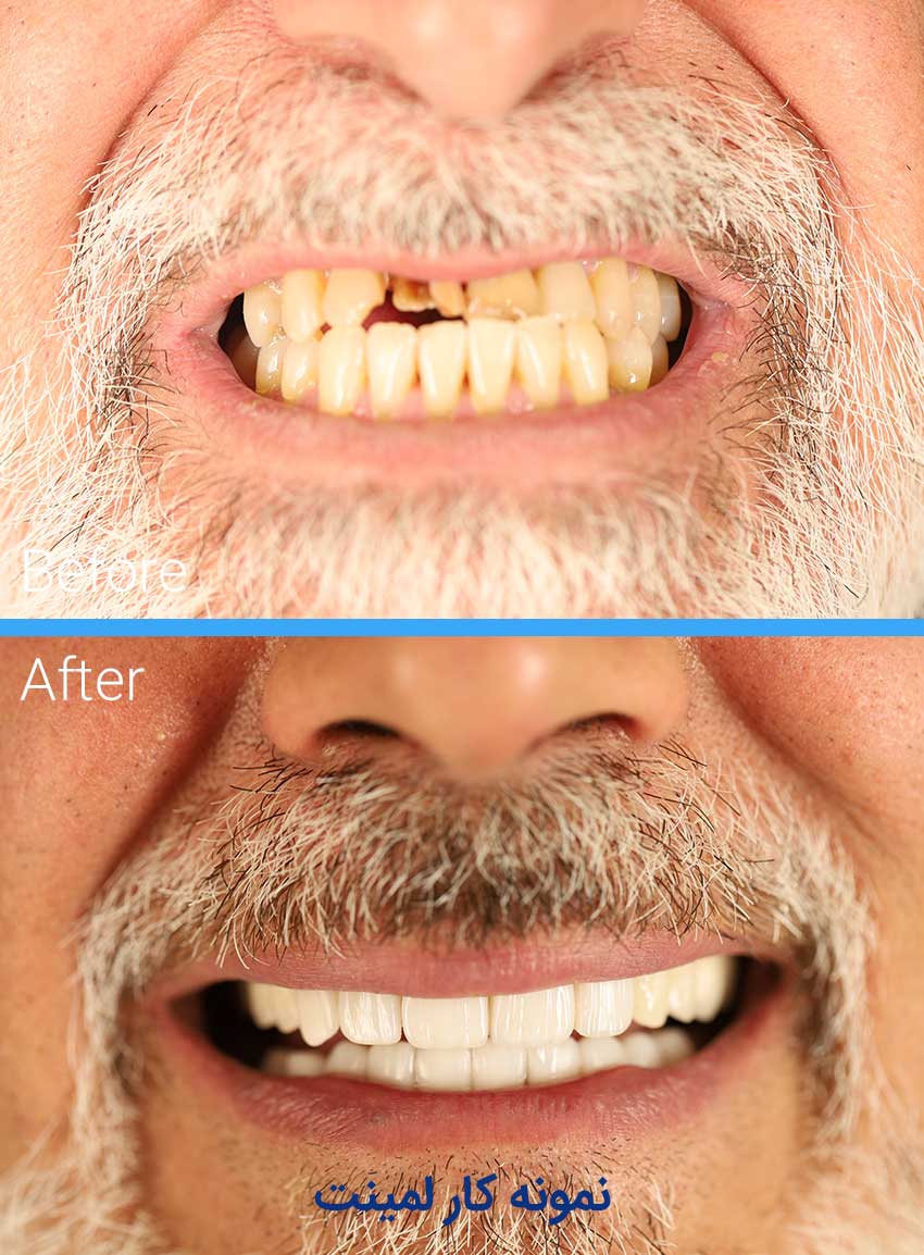 Examples-of-dental-laminate-work