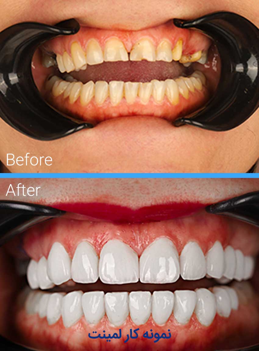 Examples-of-dental-laminate-work5