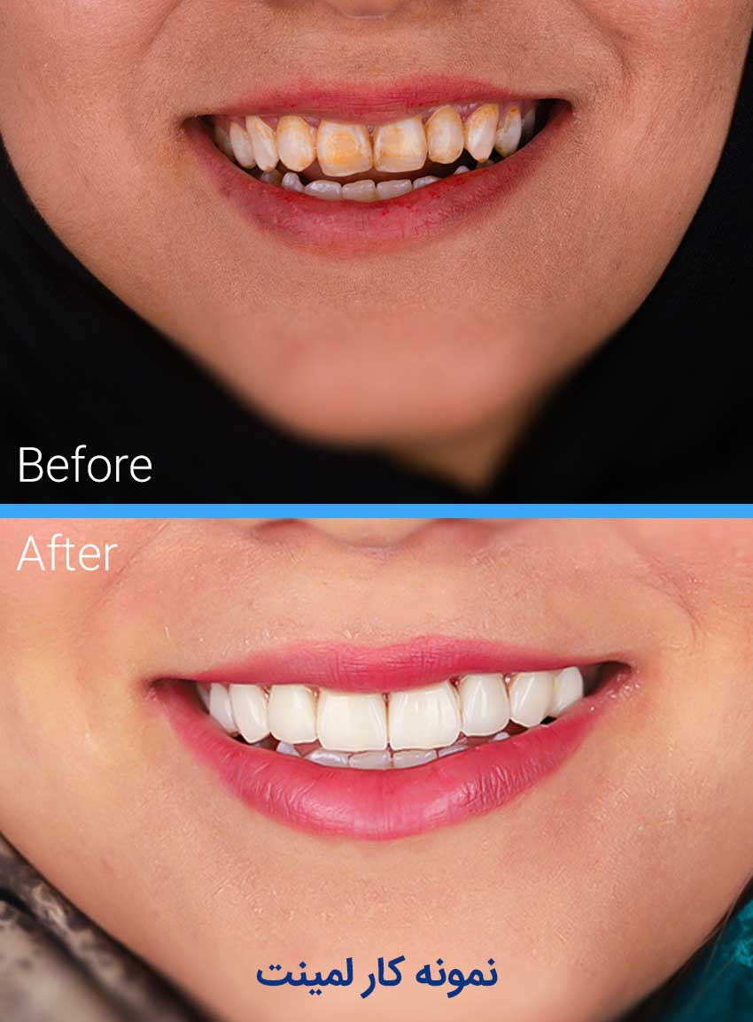 Examples-of-dental-laminate-work6