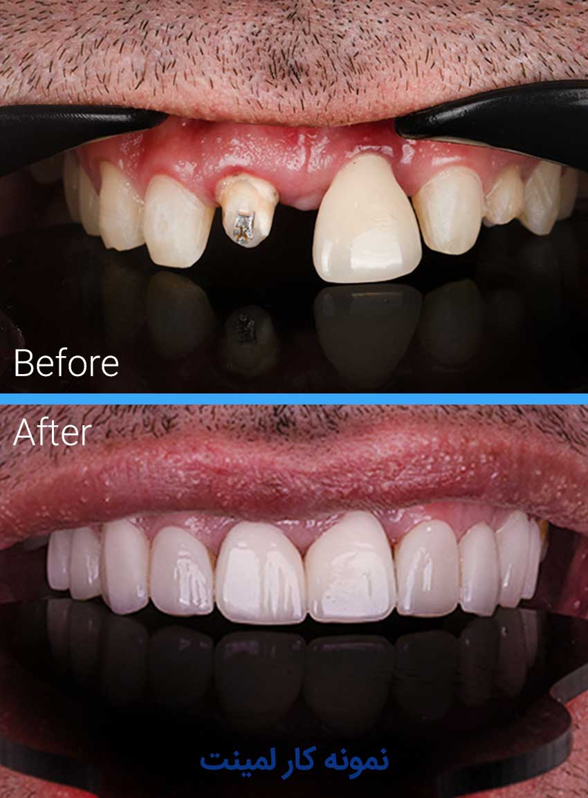 Examples-of-dental-laminate-work7