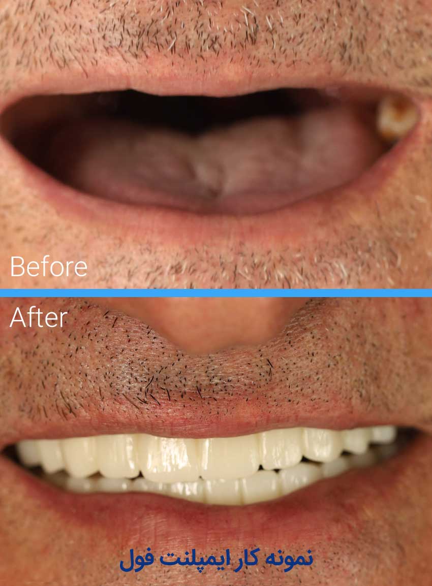 Full-implant-portfolio1