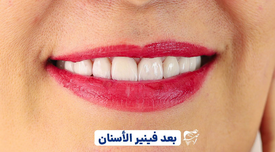After dental lamination