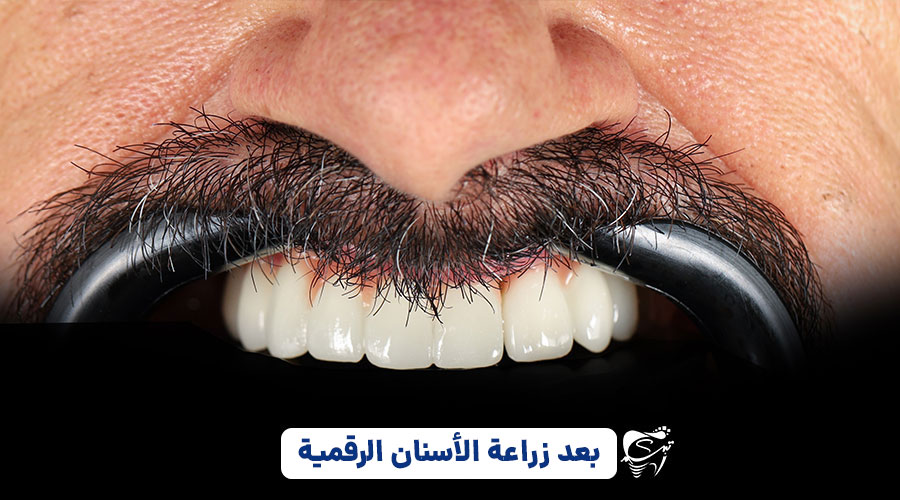 After digital implant 1