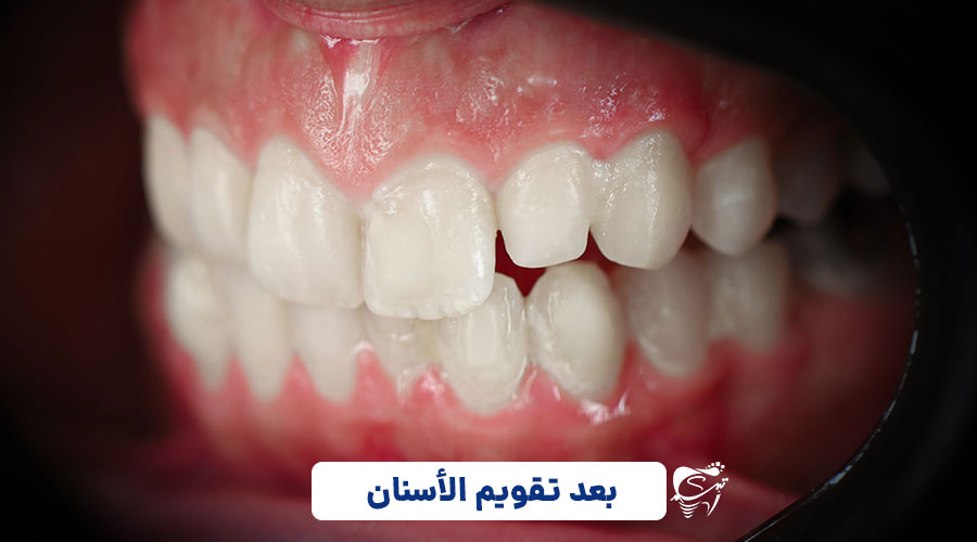 After invisible orthodontics
