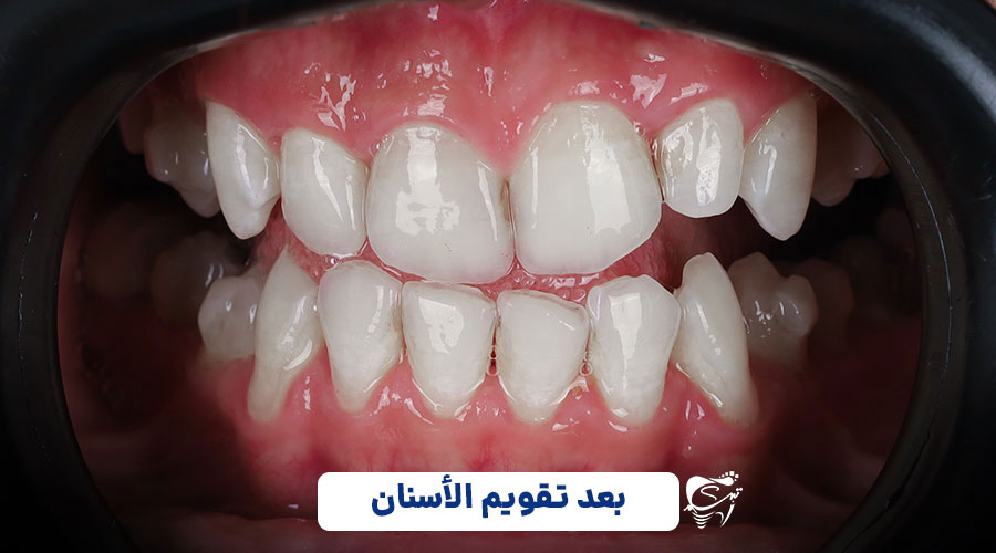 After invisible orthodontics1