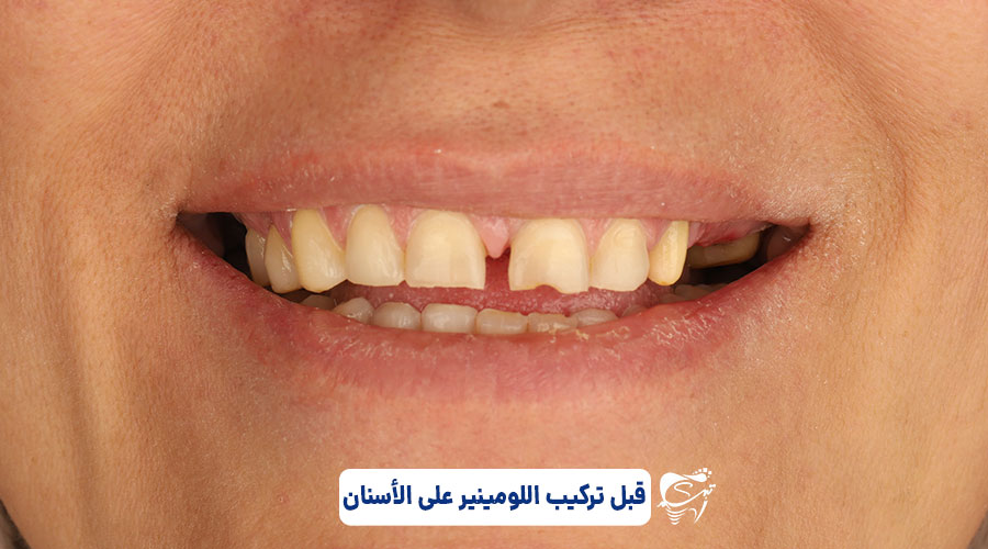 Before dental lamination