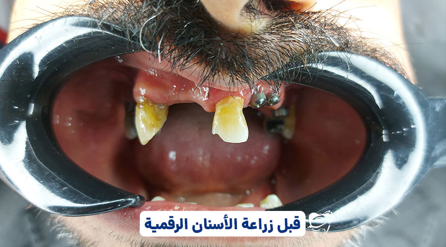 Before digital implants 1