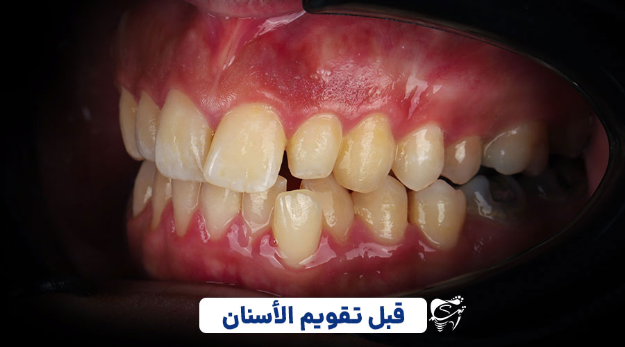 Before invisible braces