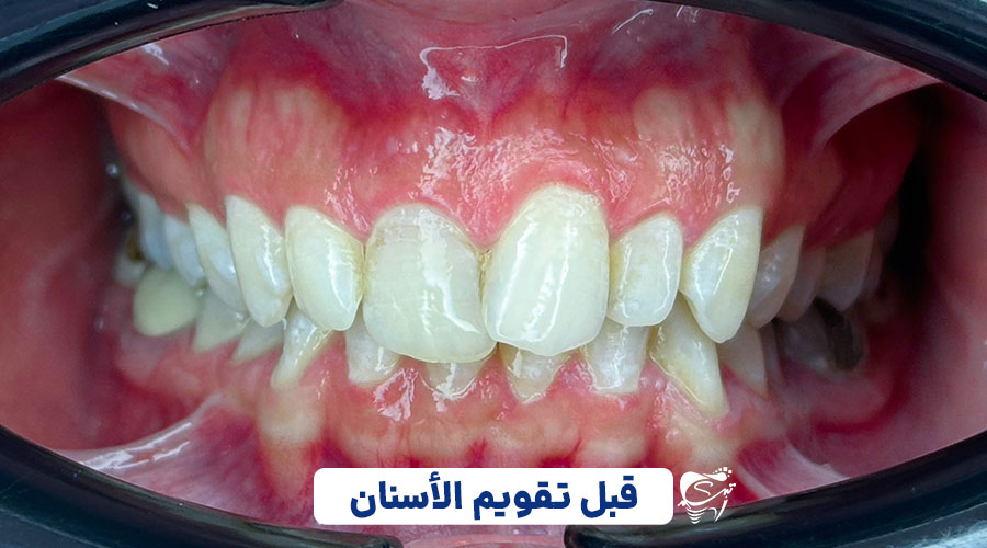 Before invisible braces1