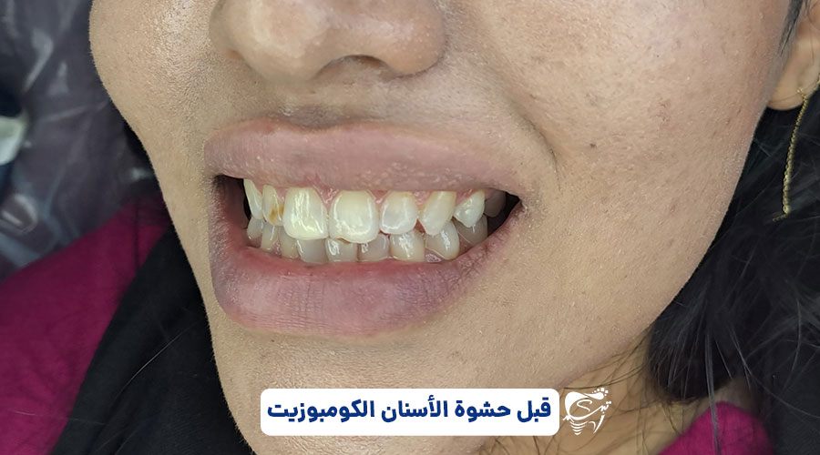 Dental composite in Shiraz