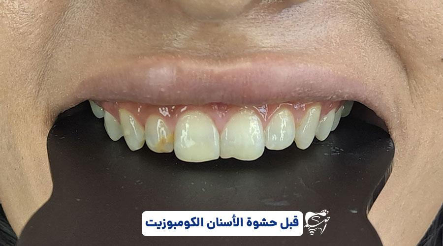 Dental composite price in Shiraz1