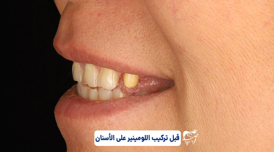 Dental laminate price in Shiraz