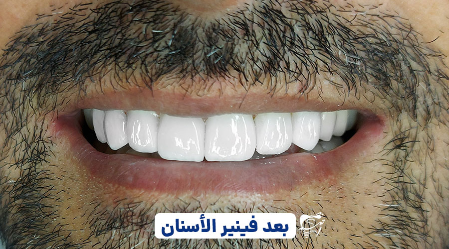 Dental laminate without milling in Shiraz