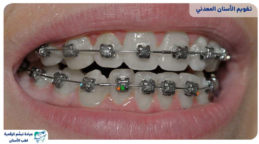 Dental wire orthodontics4