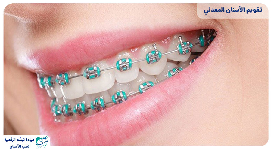 Dental wire orthodontics5