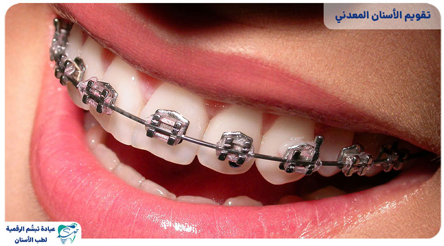 Dental wire orthodontics6