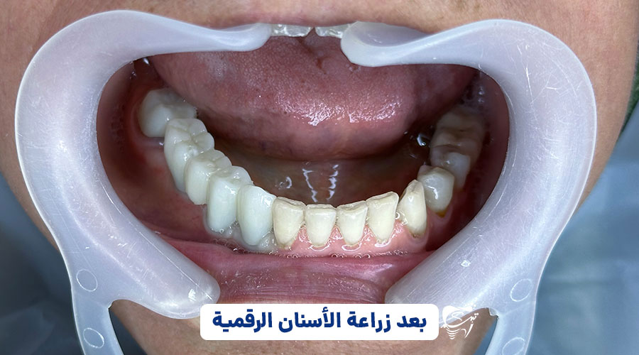 Digital implant example in Shiraz