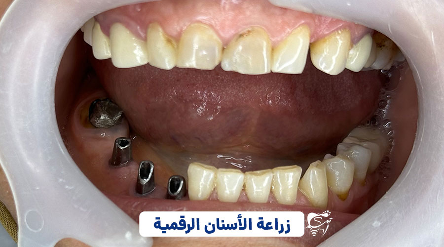 Digital implant surgery in Shiraz