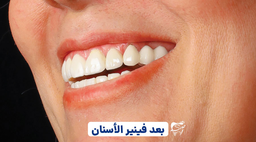 Post treatment care for dental laminates