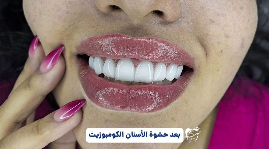 Shiraz dental composite sample
