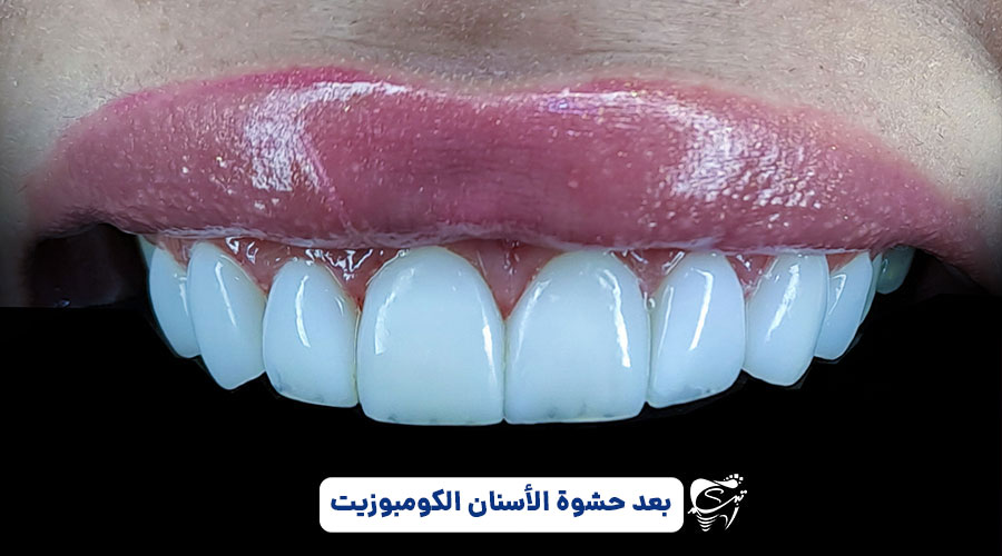 Types of dental composites in Shiraz 1