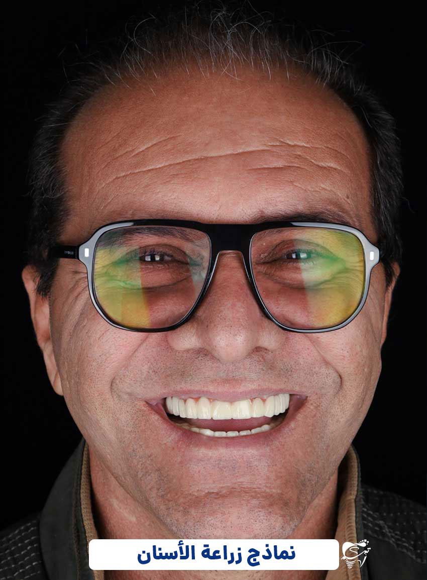 full-mousse-implant-case-study3