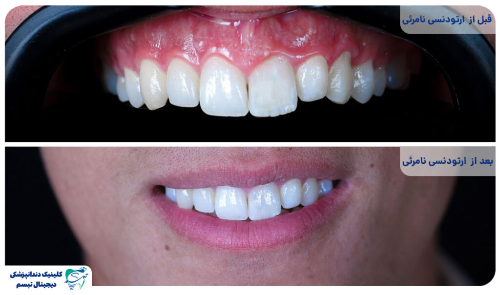 مراقبت از ارتودنسی نامرئی