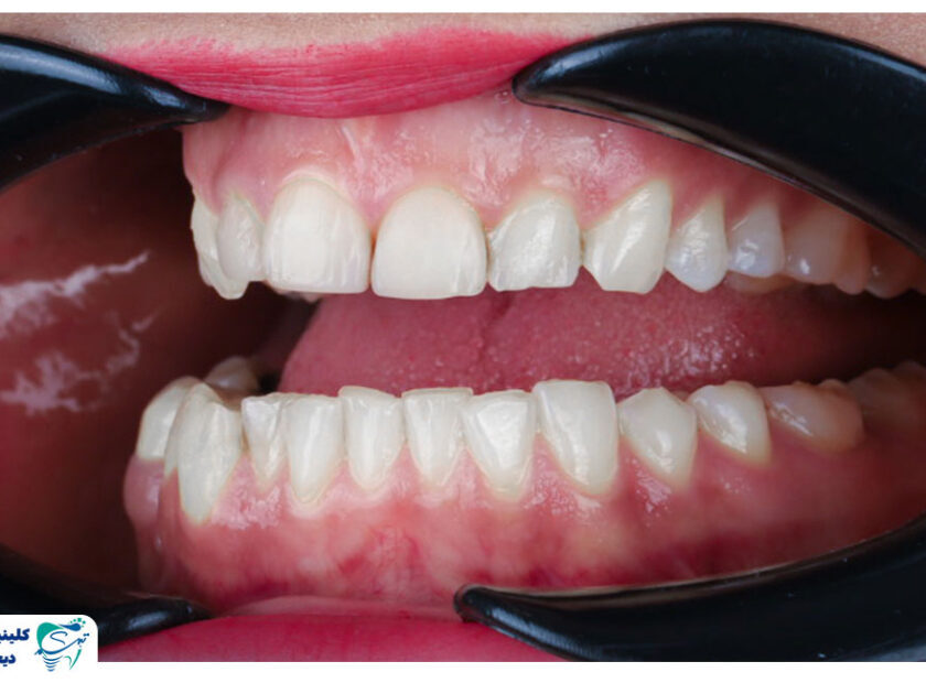 comparison of metal and invisible orthodontics 840x620