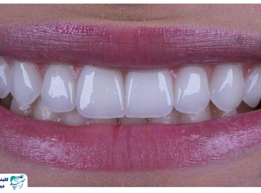 guide to choosing the color of dental laminates 1 840x620