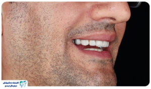 ایمپلنت دیجیتال اقساطی در شیراز