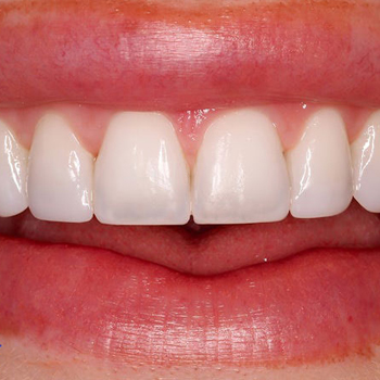 laser gum lift services
