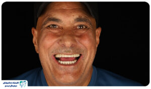 مراقبت های پس از ایمپلنت دندان