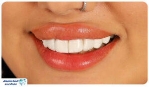 بهترین سن مناسب کامپوزیت دندان