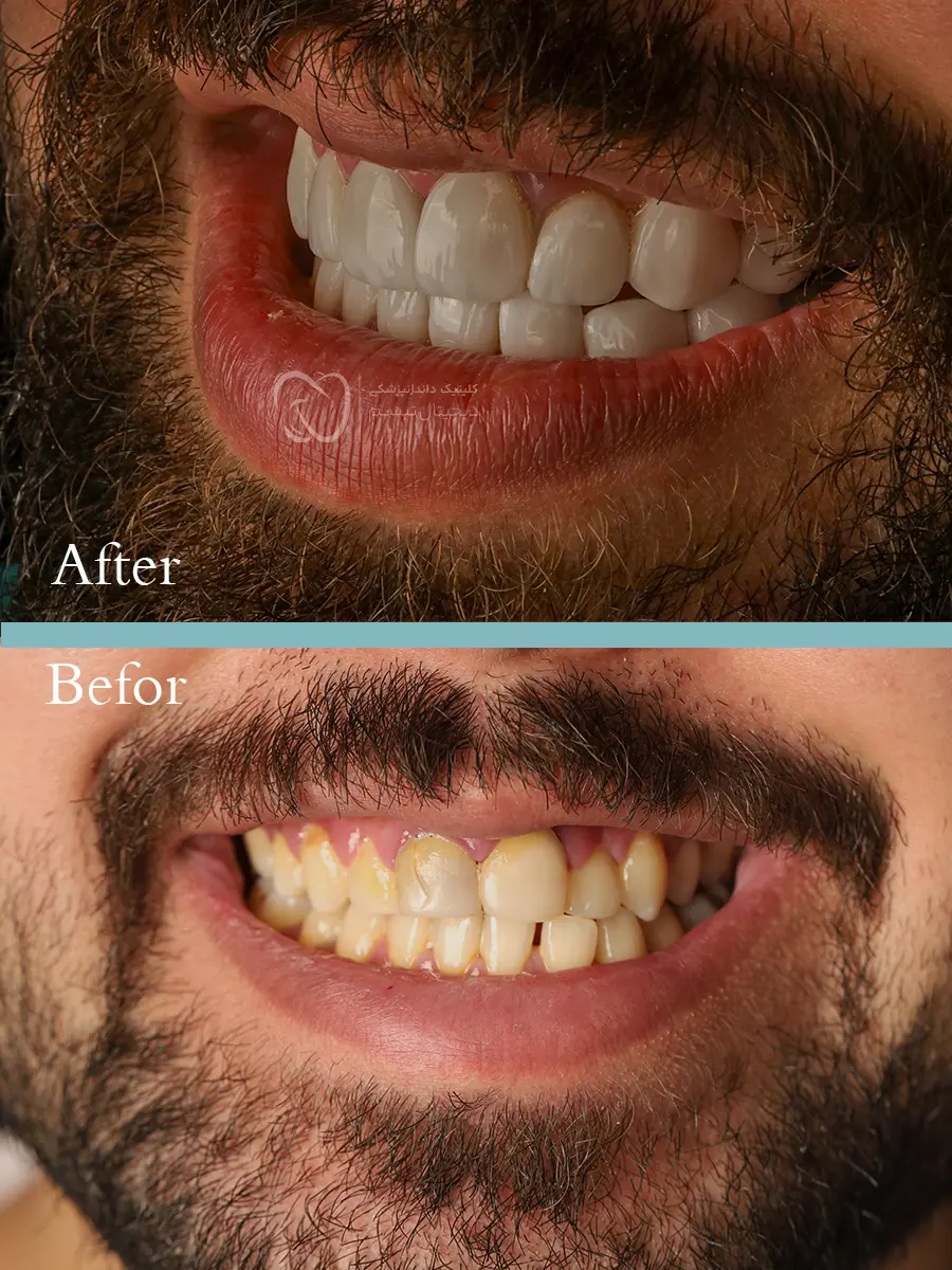 علی کنکاش قبل و بعد لمینت