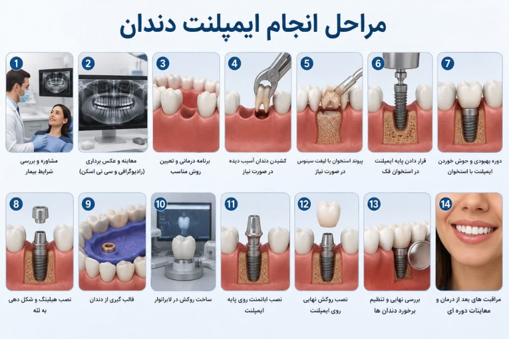 مراحل انجام ایمپلنت دندان از مشاوره تا نصب روکش