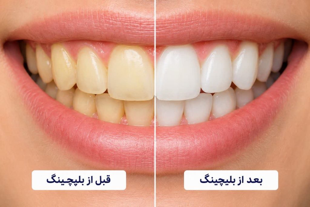قبل و بعد بلیچینگ دندان