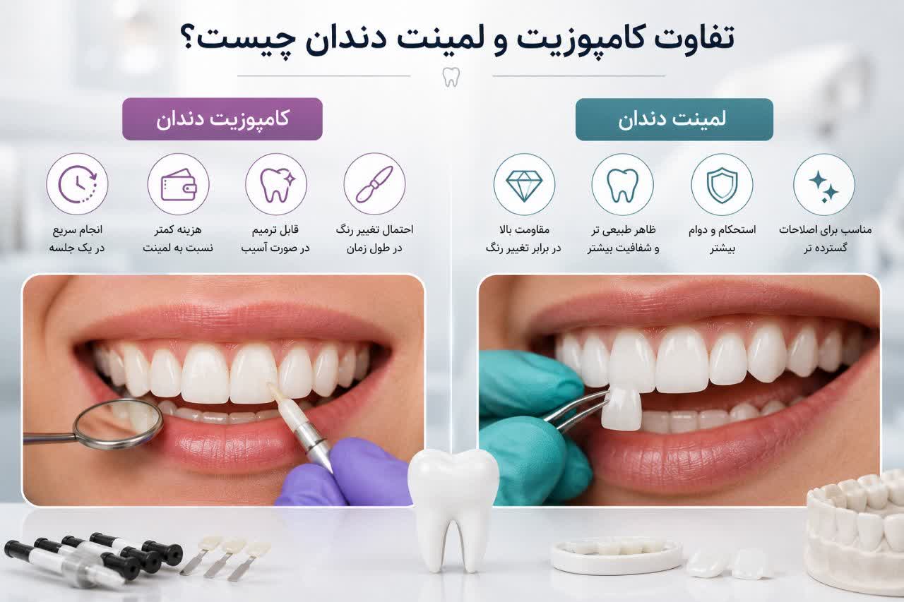 تفاوت کامپوزیت و لمینت دندان چیست؟